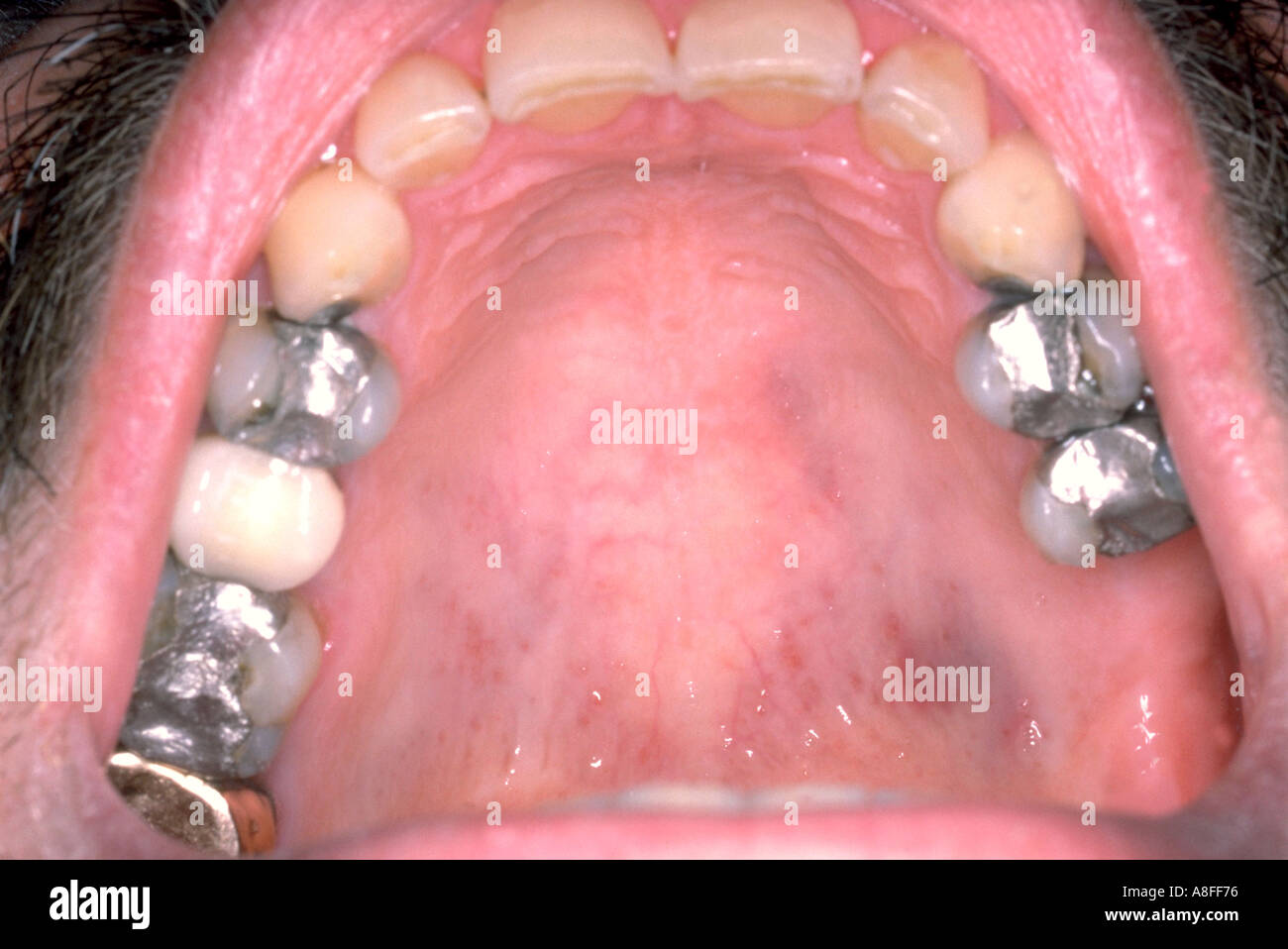 Kaposi Sarkom Stockfotos &amp; Kaposi Sarkom Bilder Alamy