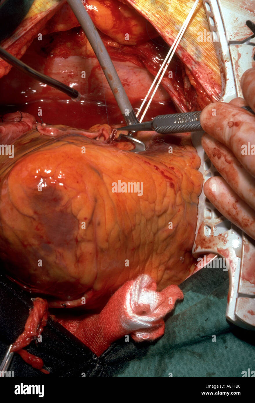 Coronary Artery Bypass Graft CABG Stockfoto