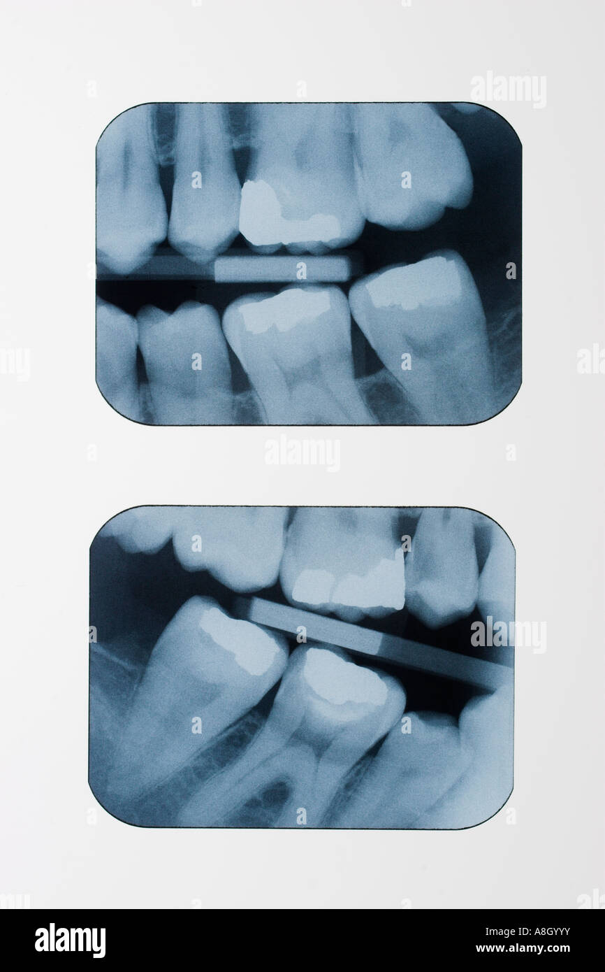 Dental Röntgenstrahlen Röntgenaufnahmen auf Leuchtkasten zeigt Füllungen und Filmträger Stockfoto