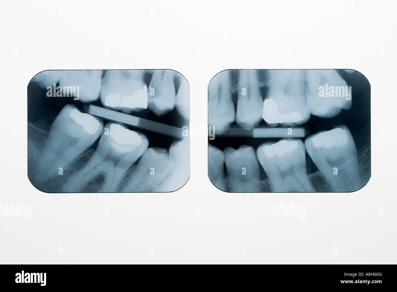Dental Röntgenstrahlen Röntgenaufnahmen auf Leuchtkasten zeigt Füllungen und Filmträger Stockfoto