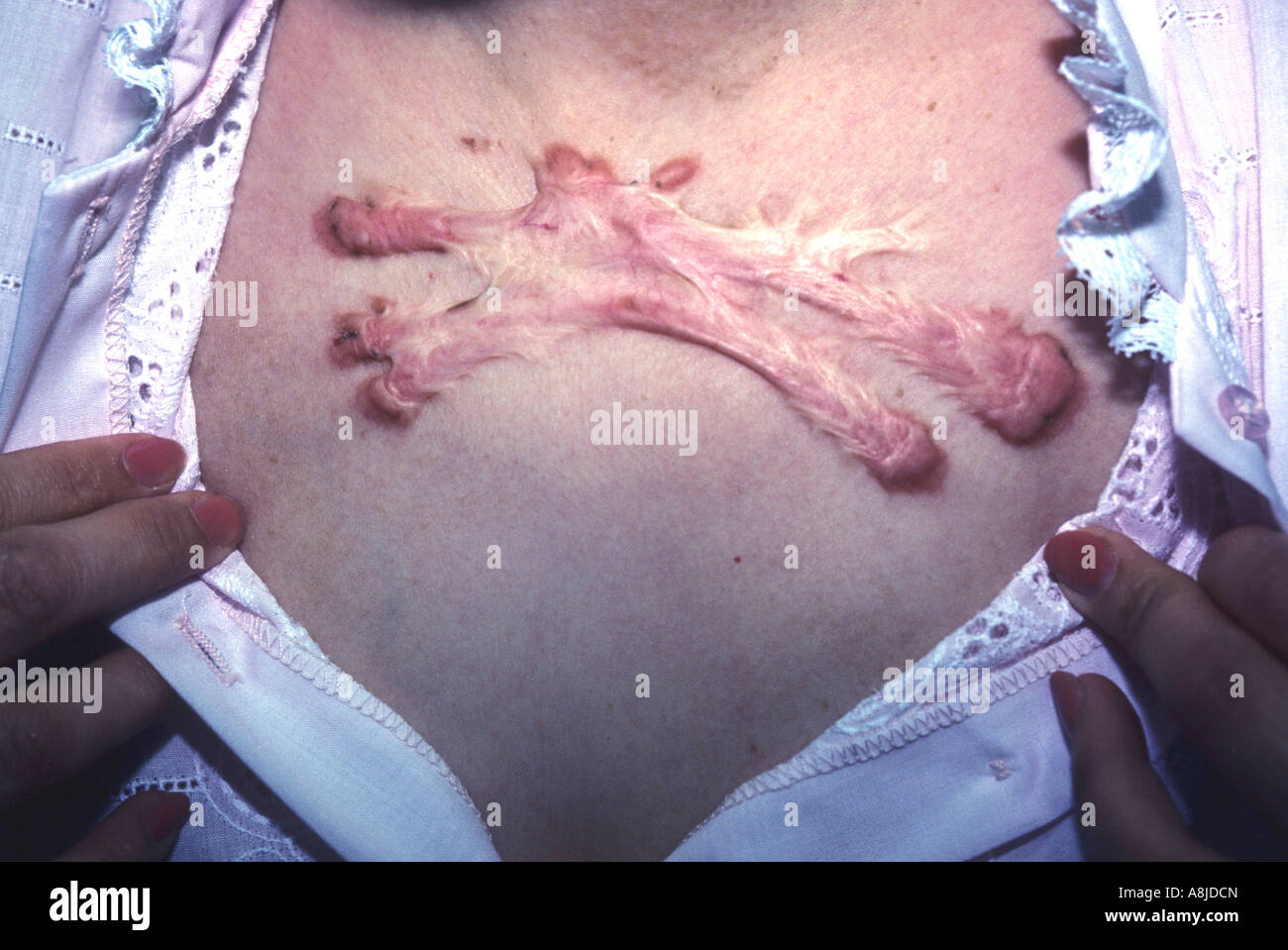 Keloide Narbe auf der Brust der Frau. Stockfoto