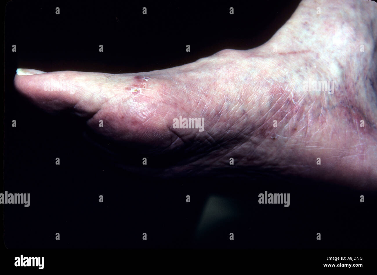 Fuß des Athleten. Die heilt, Sohlen und Seiten der Fuß zeigen eine schwache rosa Farbe mit feinen silbrig-weißen Schuppen bedeckt. Stockfoto