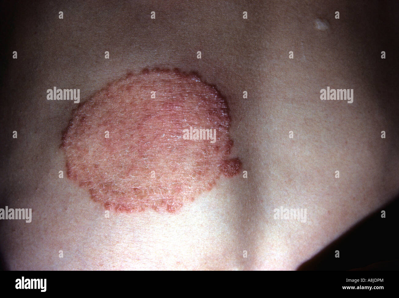 Tinea Corporis Pilzinfektion. Stockfoto