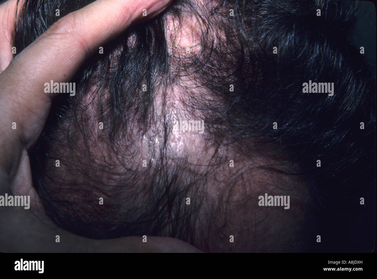 Alopecia Areata zeigt den vorzeitigen Verlust der Haare und Haarausfall Haut. Stockfoto