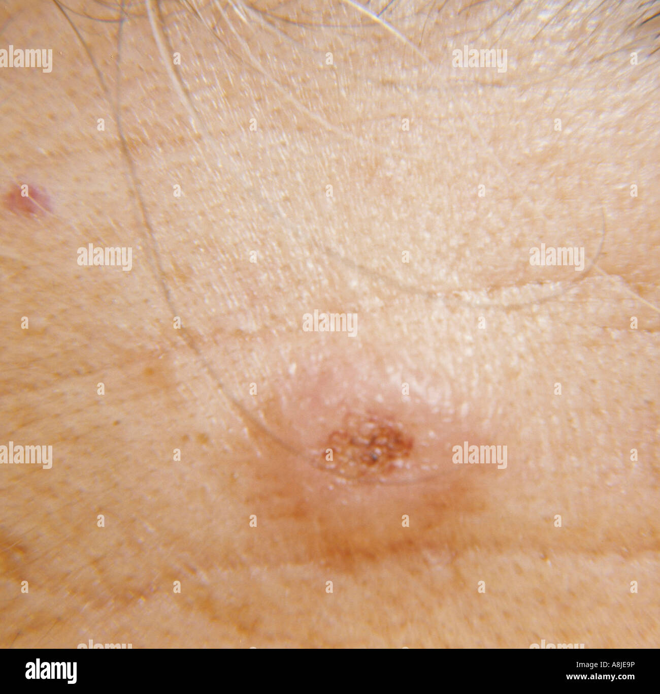 Molluscum Sebaceum: eine kuppelförmige, schnell wachsende Hautveränderung, bestehend aus gut differenzierte Plattenepithelien. Stockfoto