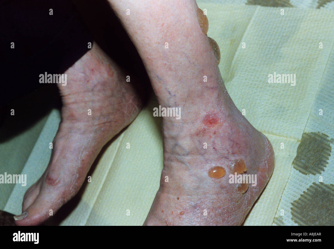 Bläschen verursacht durch Diabetes Mellitus am Bein. Stockfoto