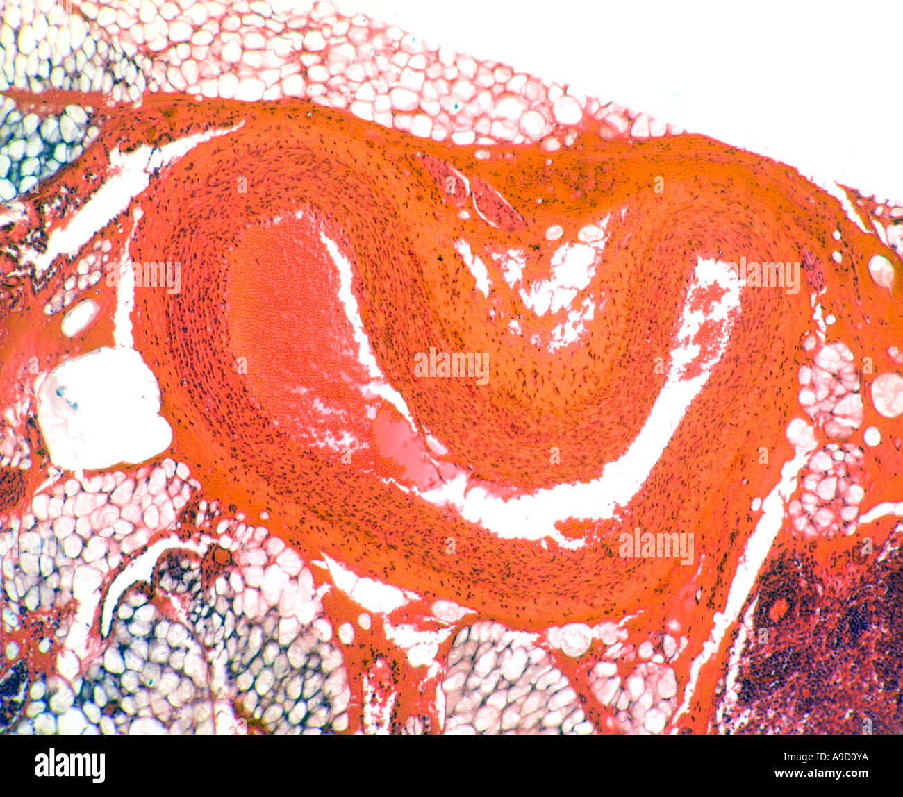 Menschliche Arterie Abschnitt Mikrophotographie, hier gezeigt eingestürzten (kein Blut im Inneren) Stockfoto