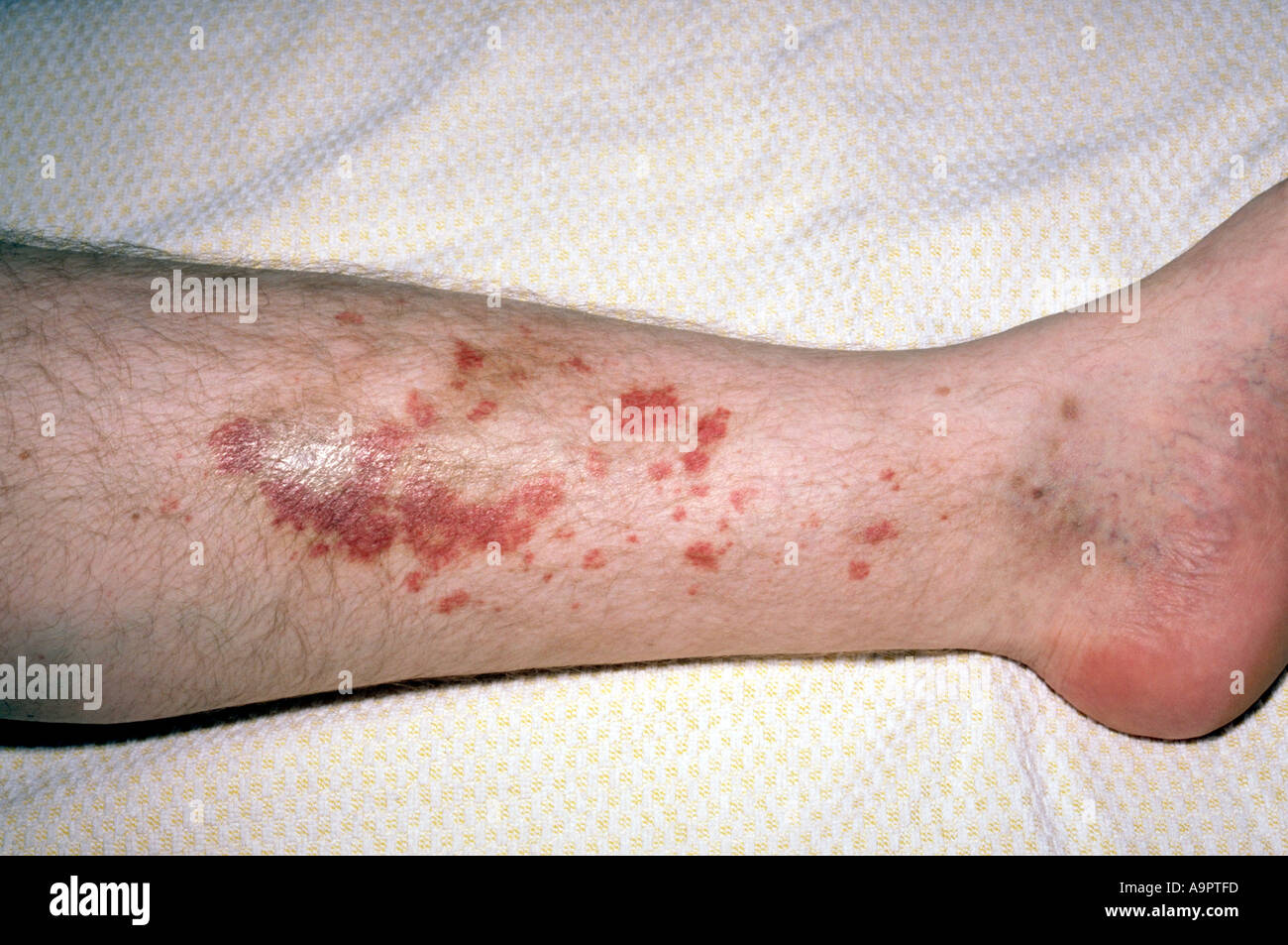 Purpura rash Stockfotos und -bilder Kaufen - Alamy