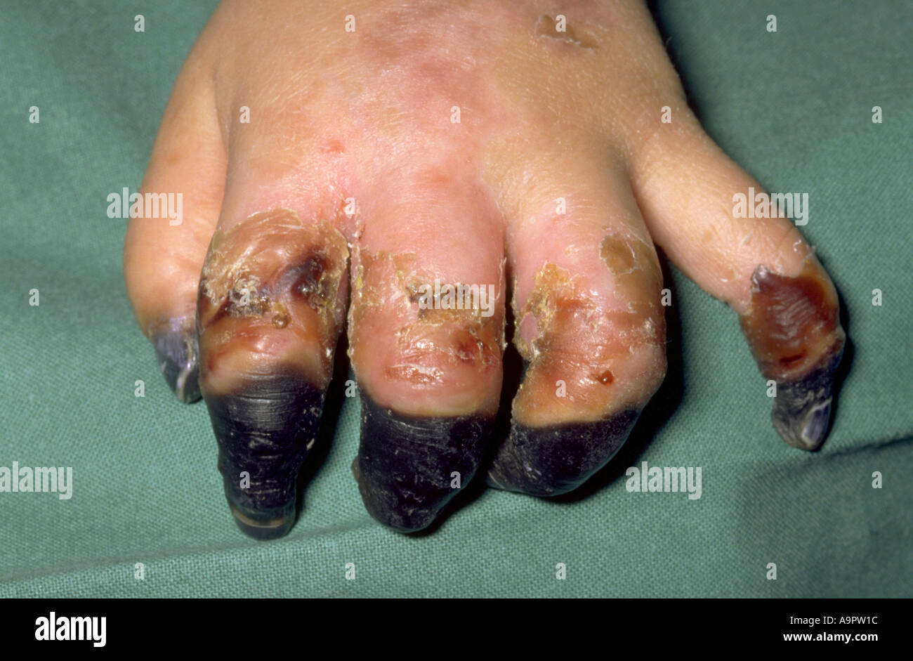 Nekrotische Finger Meningokokken-Erkrankungen Stockfoto