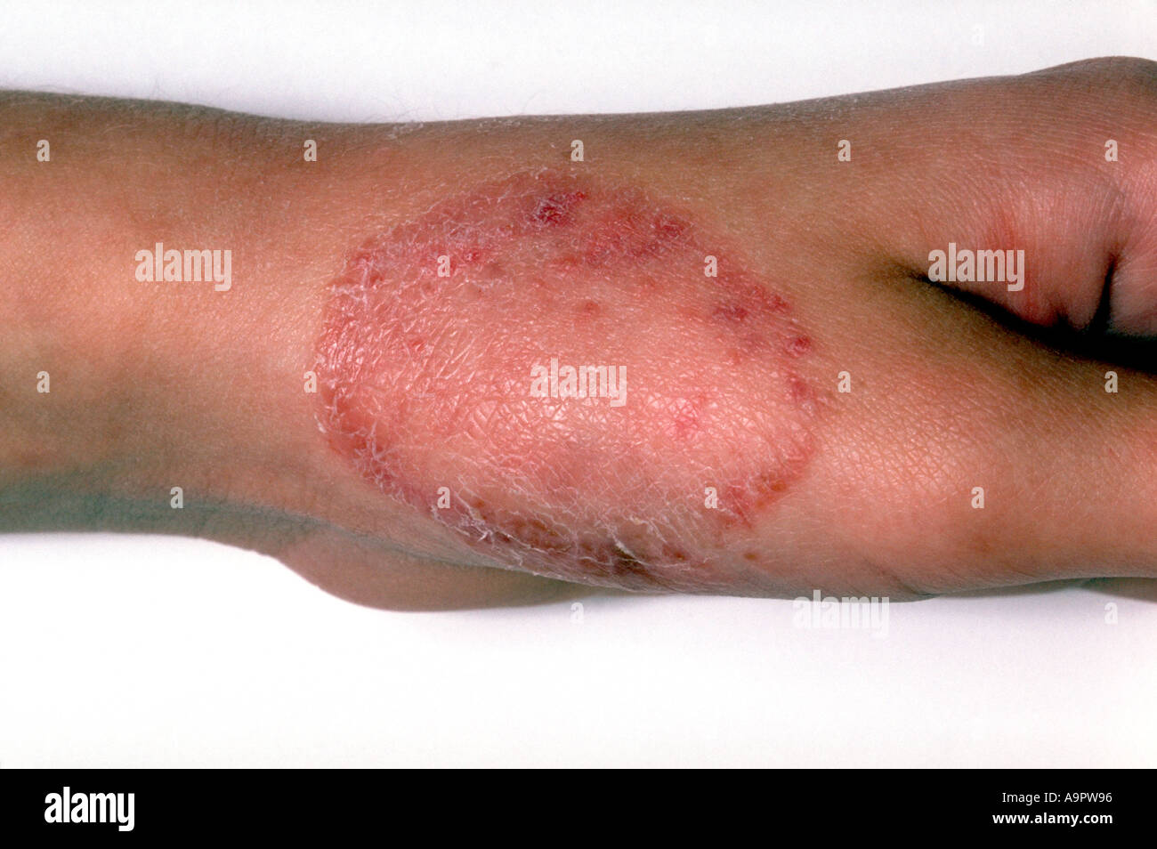 Scherpilzflechte Stockfoto