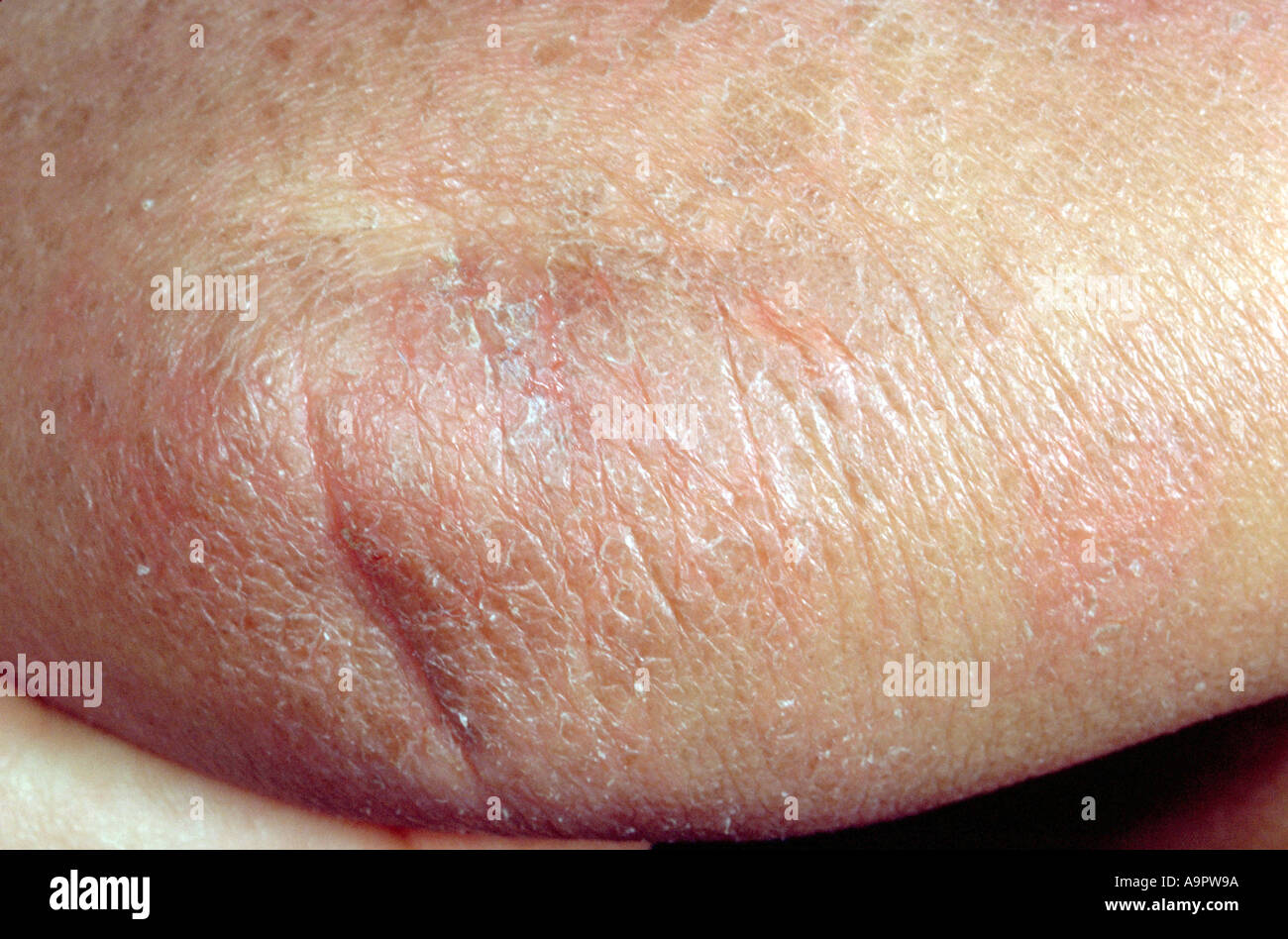 Atopisches Ekzem Stockfoto, Bild: 4055449 - Alamy