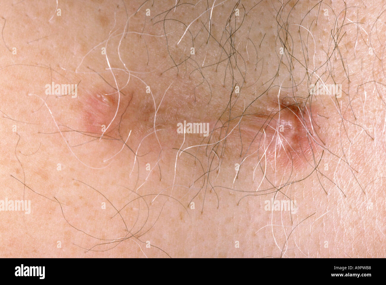 Hypertrophe Narbe Stockfoto