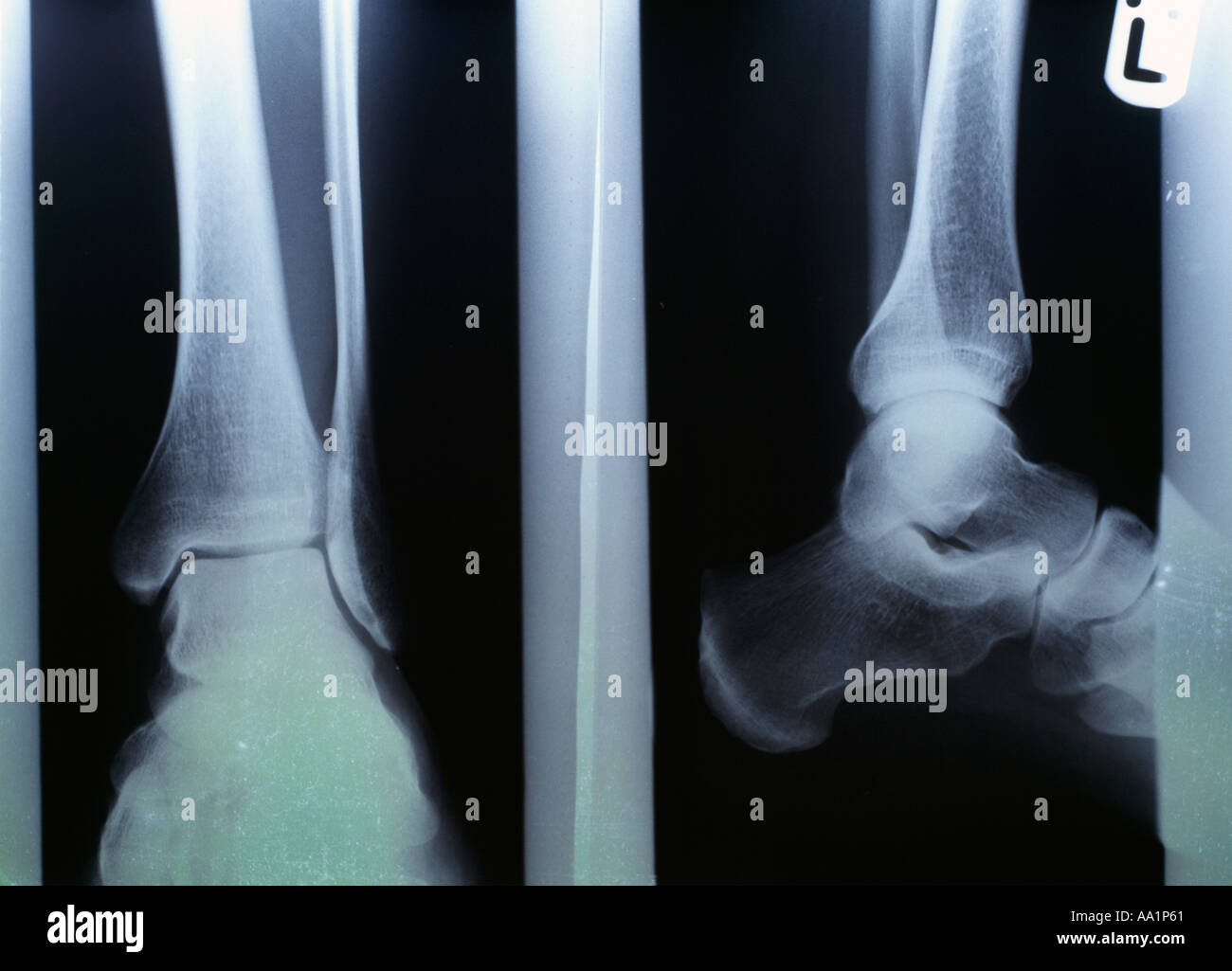 Knochen-Xray recht männlichen menschlichen Gliedmaßen, Stockfoto