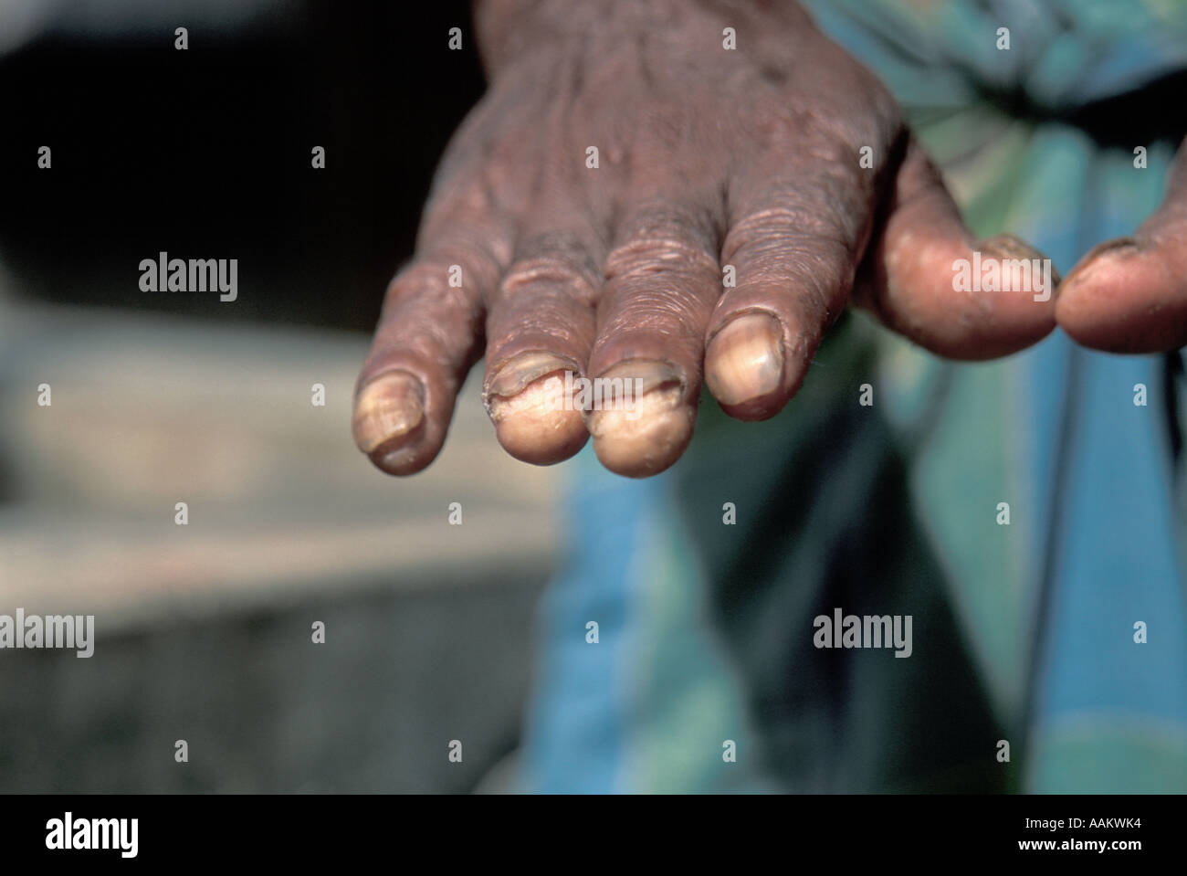 Landleben-Arsen Vergiftung Symptome - "Teufelswasser" "Grte Masse  Vergiftung von Menschen je gekannt" Reportage Stockfotografie - Alamy