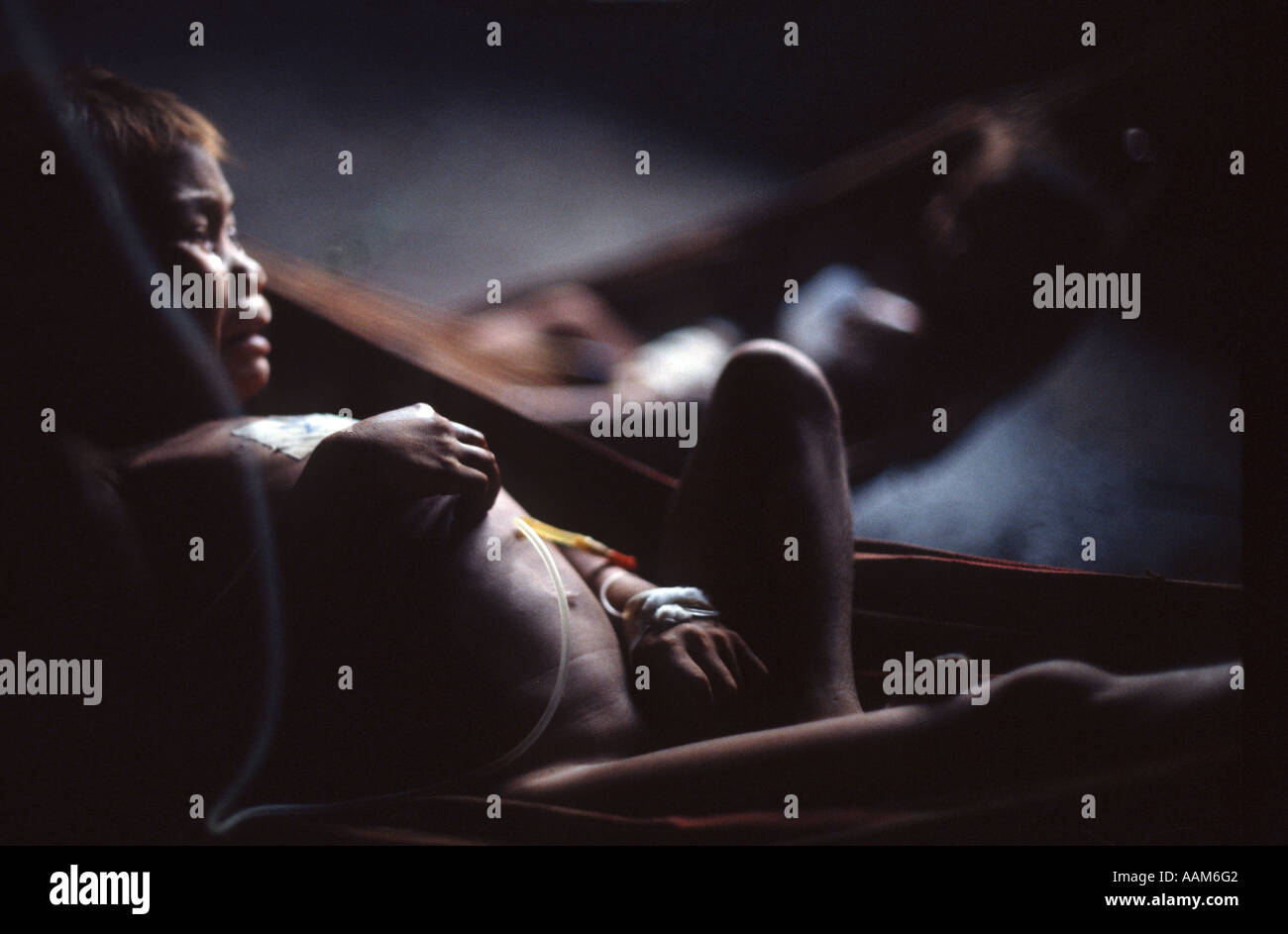 Amazonas, Brasilien. Indigenen Völker. Krankes Ianomami Kind mit Malaria. Stockfoto