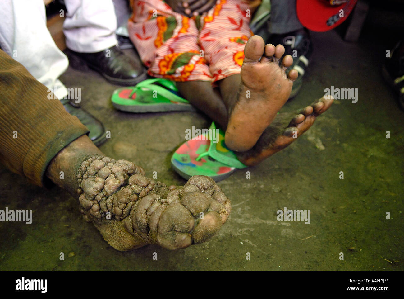Ein Mann mit einer chronisch entzündlichen Podokoniose in seinen Füßen. Provinz Nord-Kivu DR Kongo Afrika Stockfoto