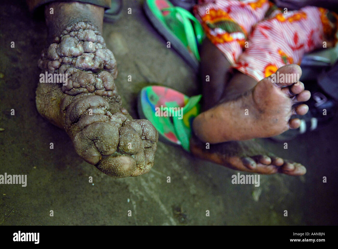 Ein Mann mit einer chronisch entzündlichen Podokoniose in seinen Füßen. Provinz Nord-Kivu DR Kongo Afrika Stockfoto