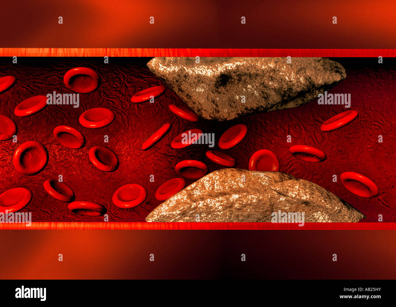 Blutgefäß Blutgefäß mit Arteriosklerose Gefäßverkalkung Stockfoto