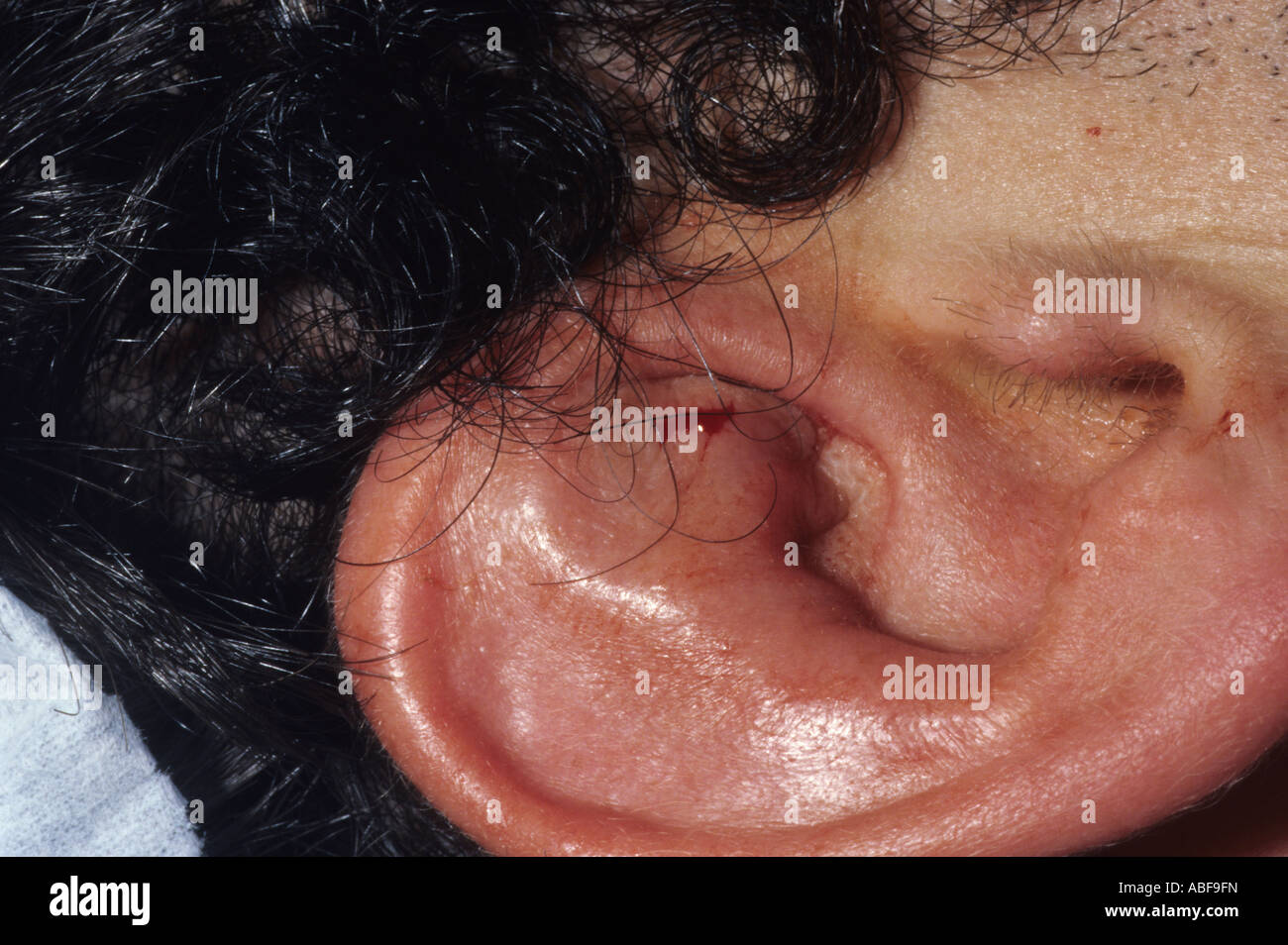 Ohren geschwollene Geschwollene Lymphknoten: