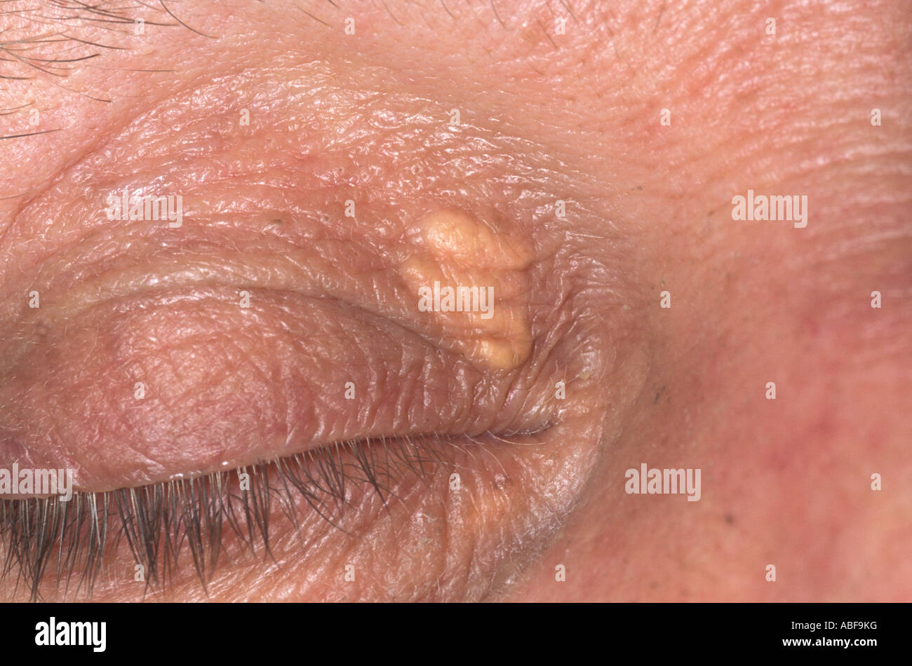 Xanthelasmagelbe flache Plaques in der Regel finden Sie auf der medialen Aspekt des Augenlids