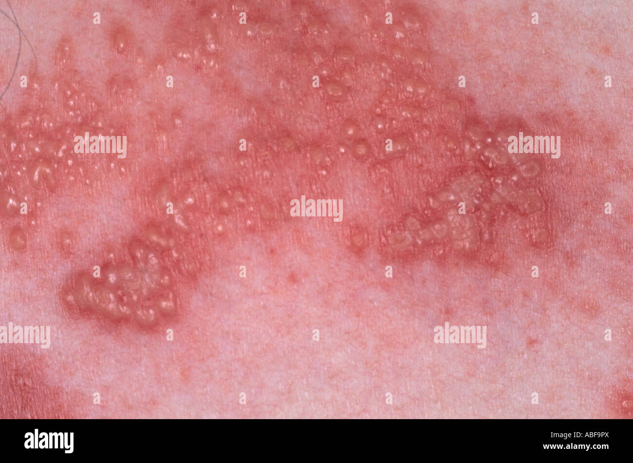 Dermatome Stockfotos und -bilder Kaufen - Alamy