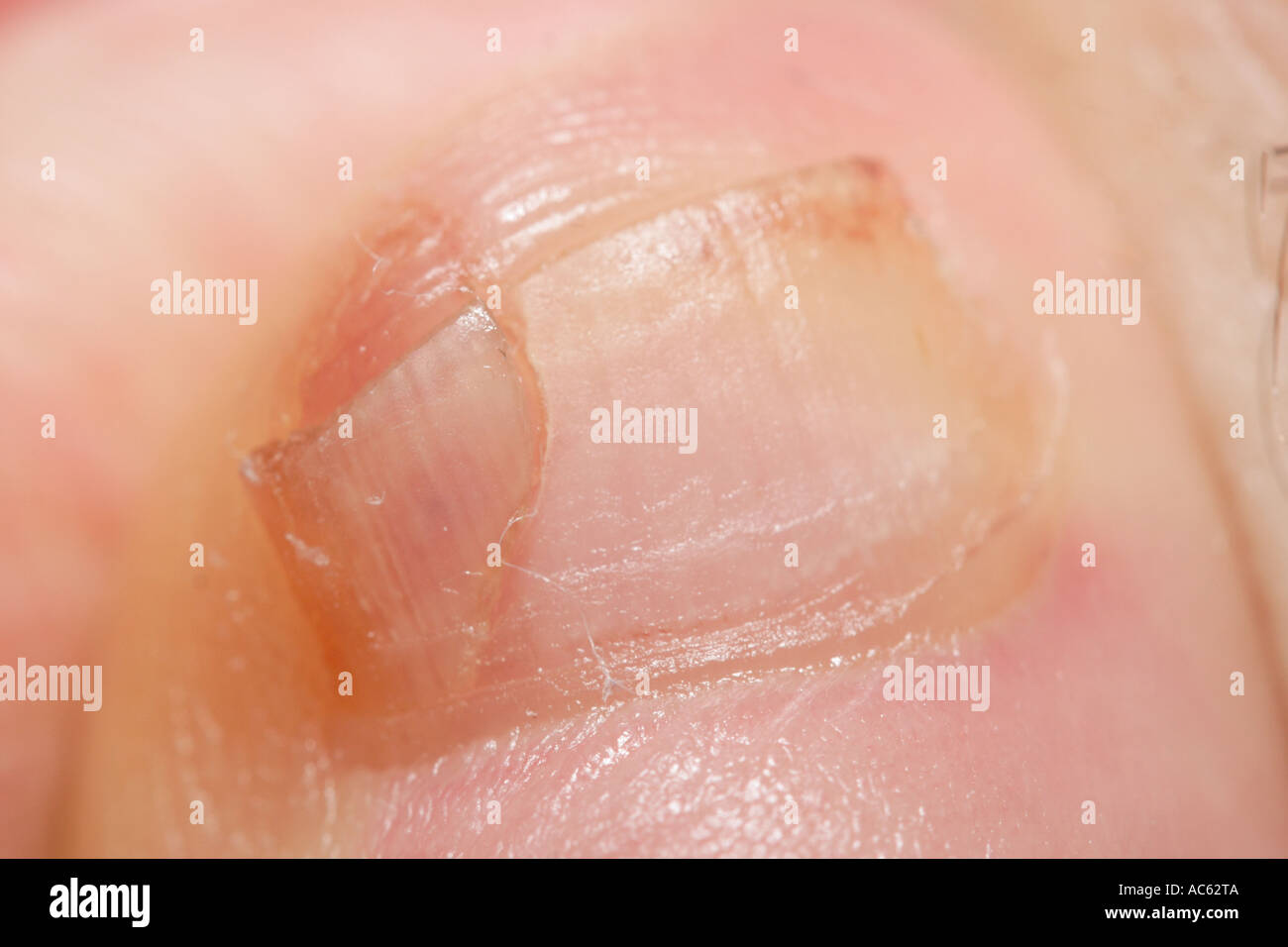 Gebrochenen Zehennagel am kleinen Zeh Stockfoto