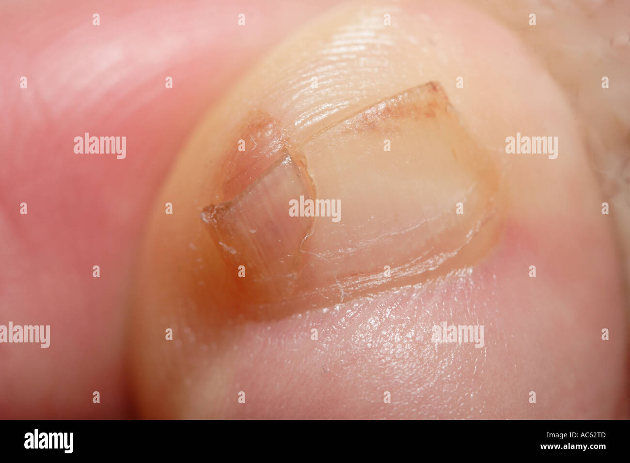 Gebrochenen Zehennagel am kleinen Zeh Stockfoto