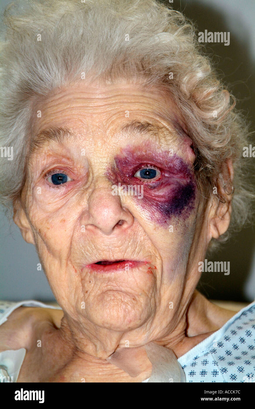 85 Jahr alt senior weiblich verletzt Auge nach dem Kopf fallen und auffällig auf einem Tisch Stockfoto