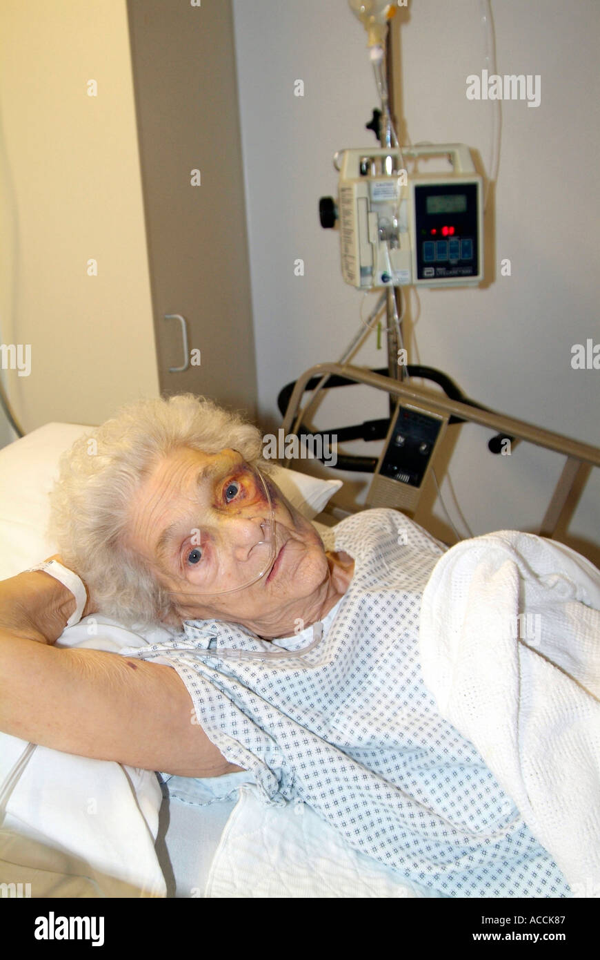 85 Jahr alt senior weiblich verletzt Auge nach dem Kopf fallen und auffällig auf einem Tisch Stockfoto