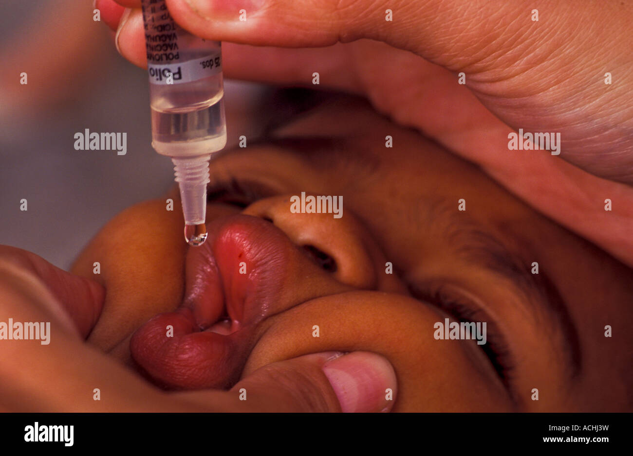 kinderlahmung stockfotos und bilder kaufen alamy