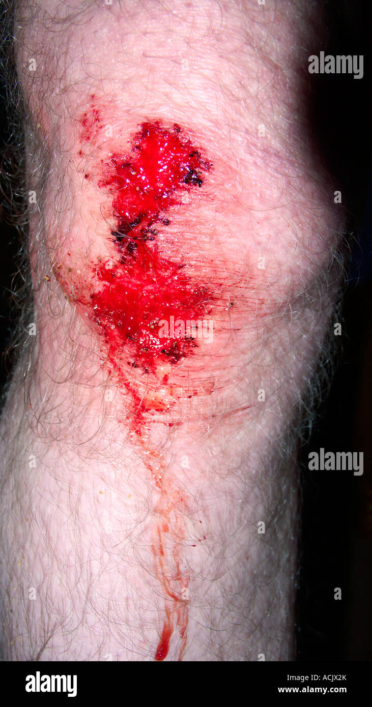 Eine Blutung die Verletzung Knie setzte sich beim Fußball spielen auf  Kunstrasen Stockfotografie - Alamy