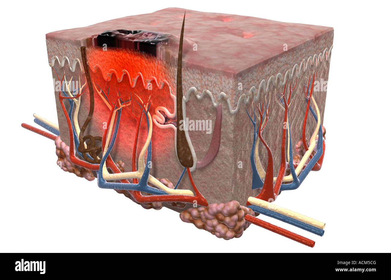 Malignes Melanom Stockfoto