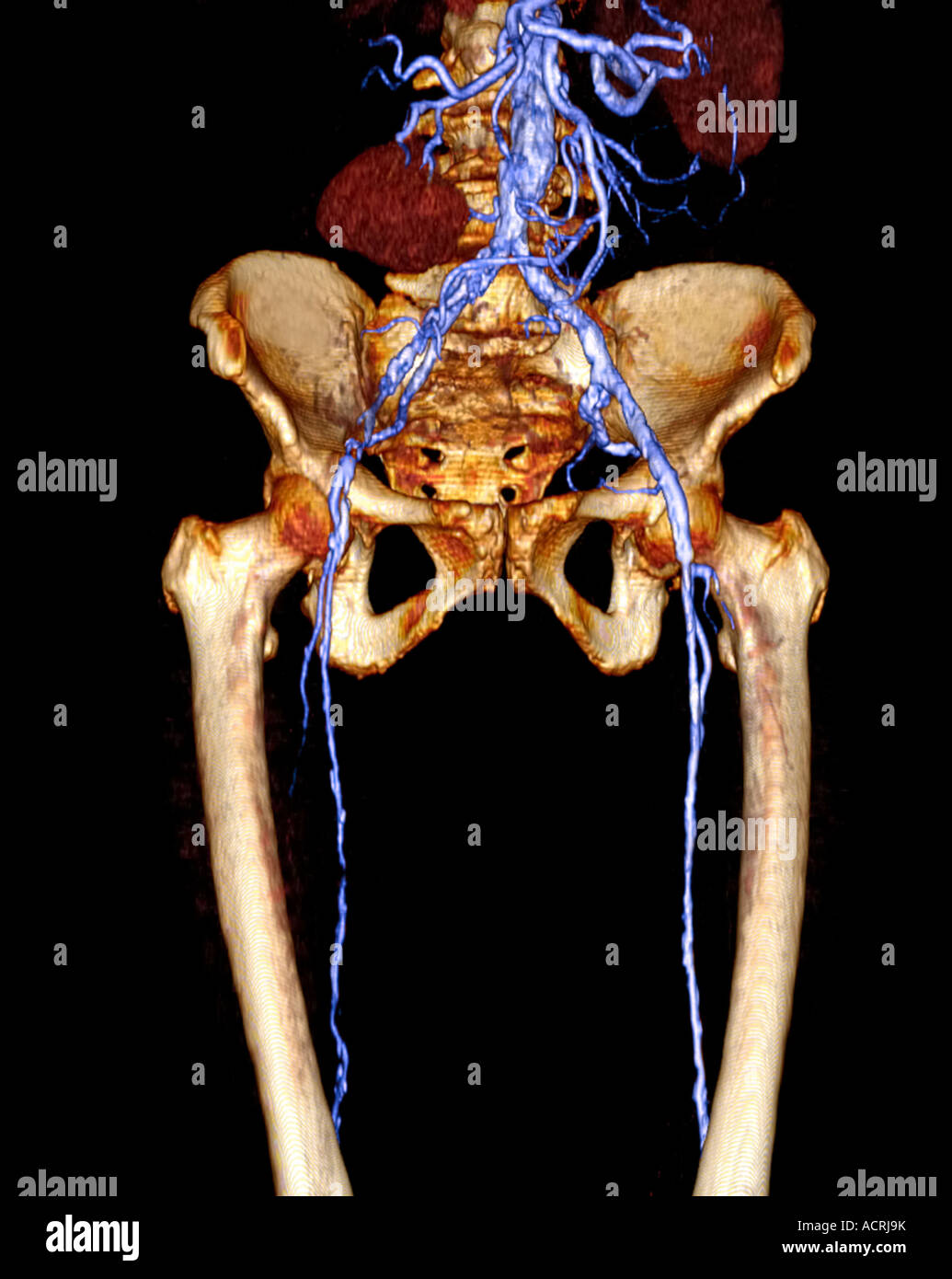 3D CT-Scan zeigt 83 Jahre alte Frau mit rechten Beckenkamm Arterie Okklusion und schweren Athersclerotic Krankheit Stockfoto