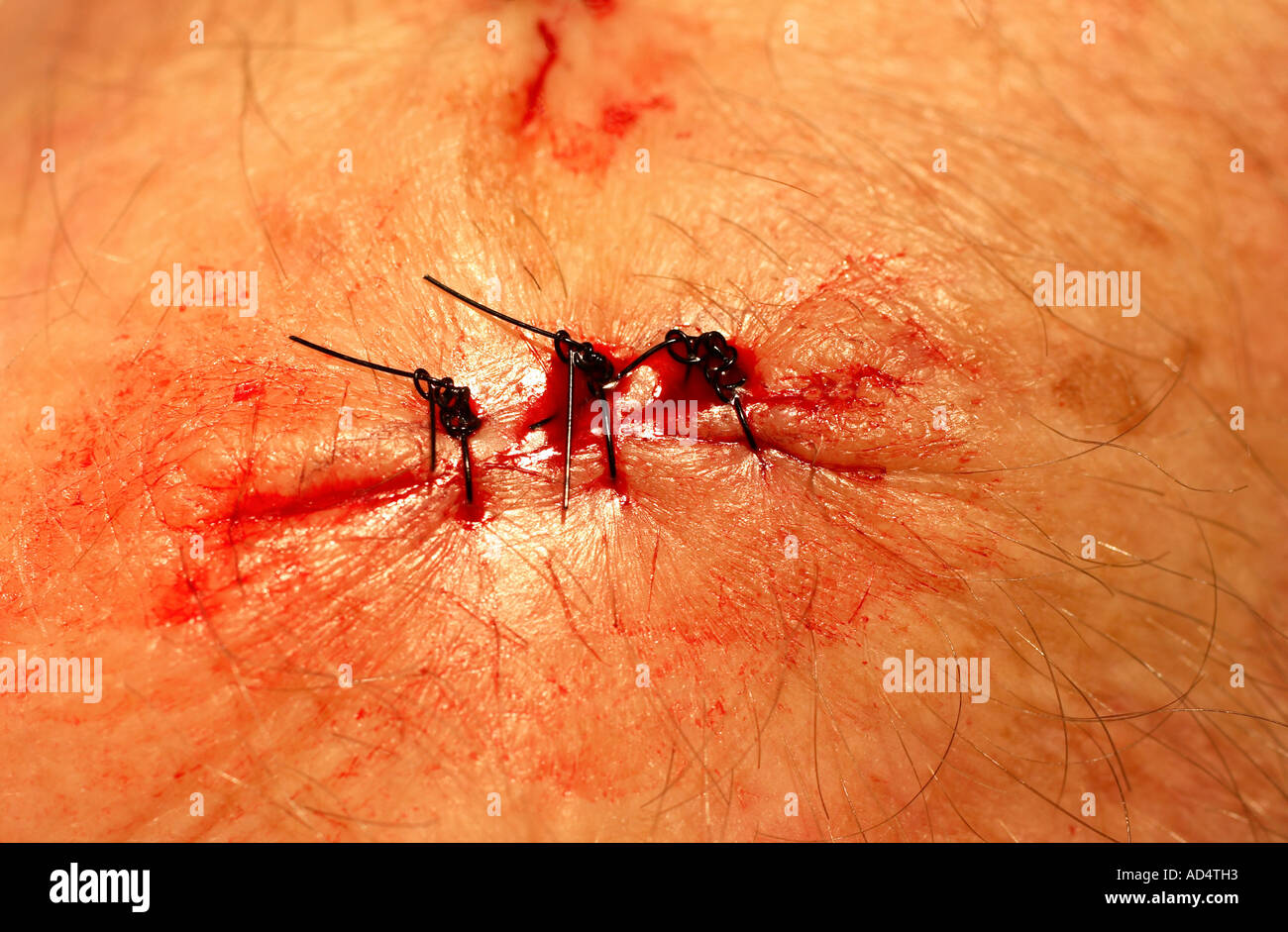 drei Fäden in einer Wunde nach der Haut Krebsoperation Stockfoto