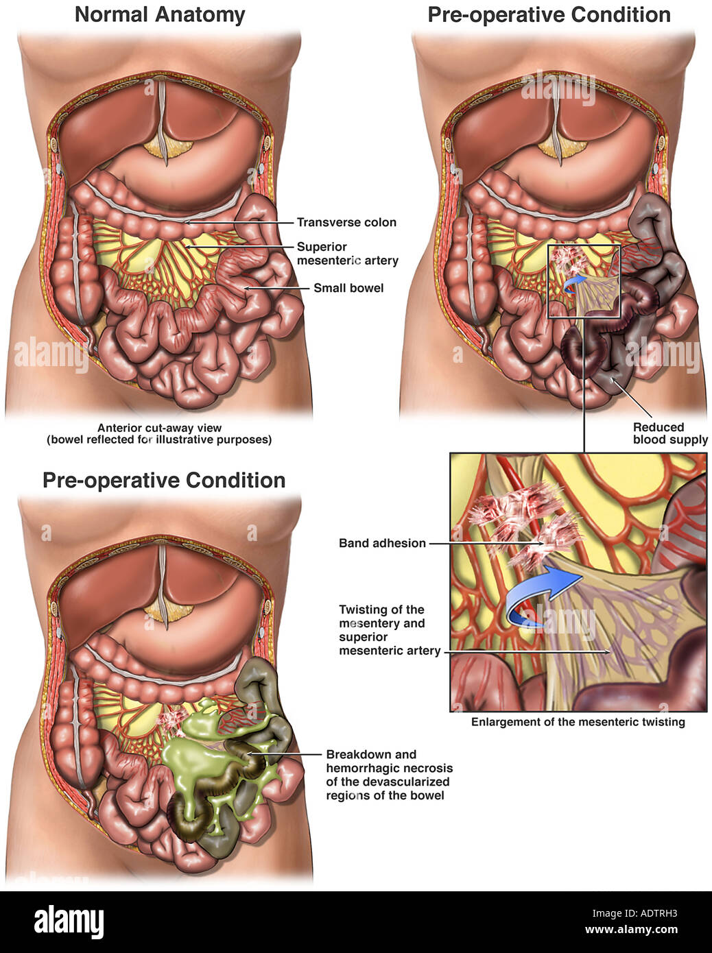 Darmverschluss Fotos und Bildmaterial in hoher Auflösung Alamy