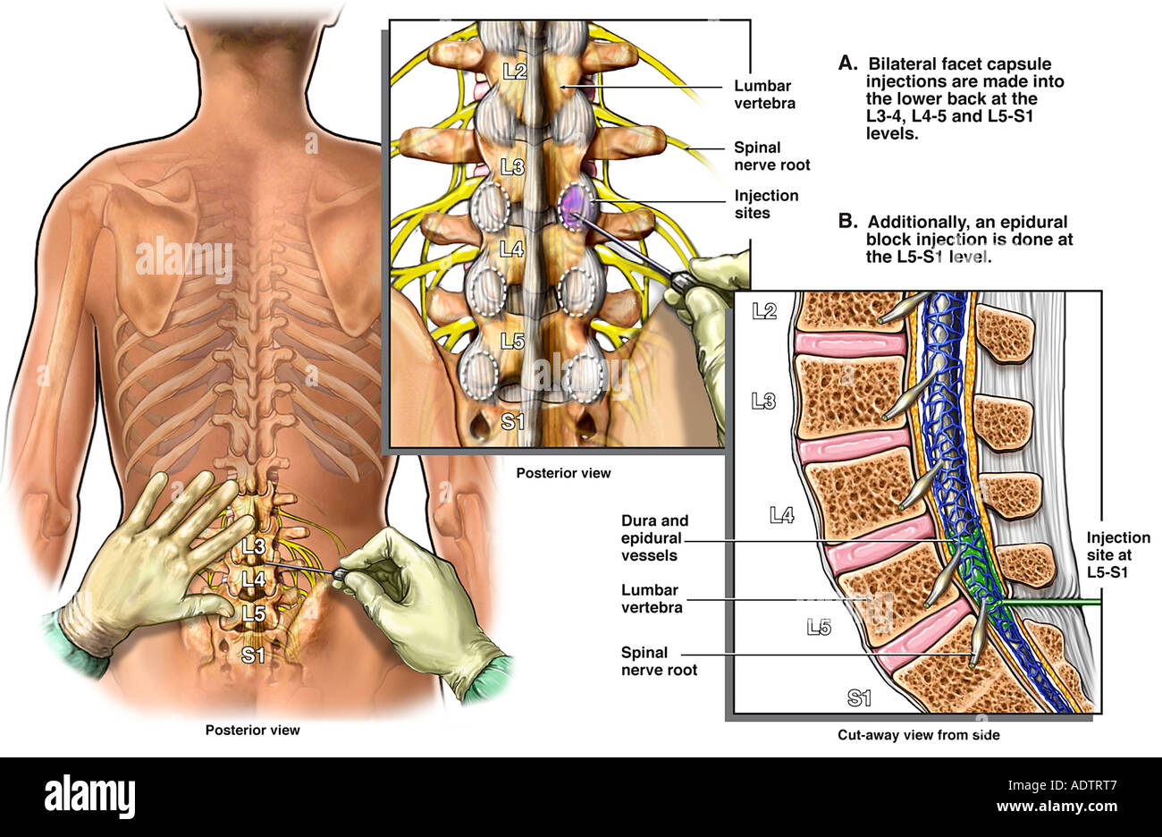 Lumbale Facette und epidurale Block Injektionen Stockfoto, Bild