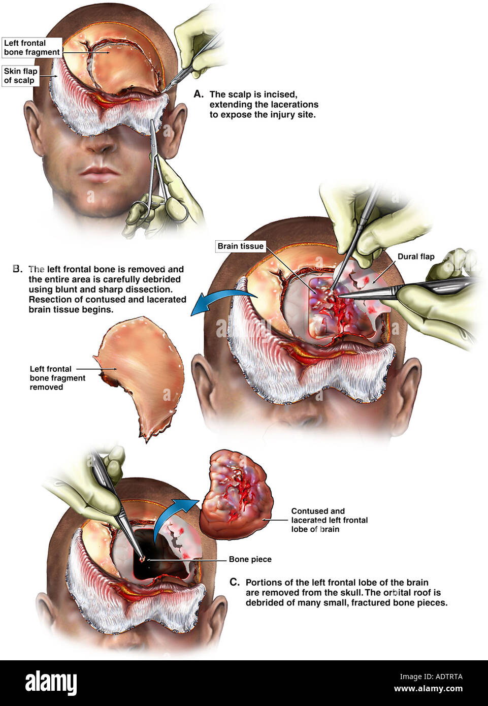 Lobektomie Stockfotos Und Bilder Kaufen Alamy
