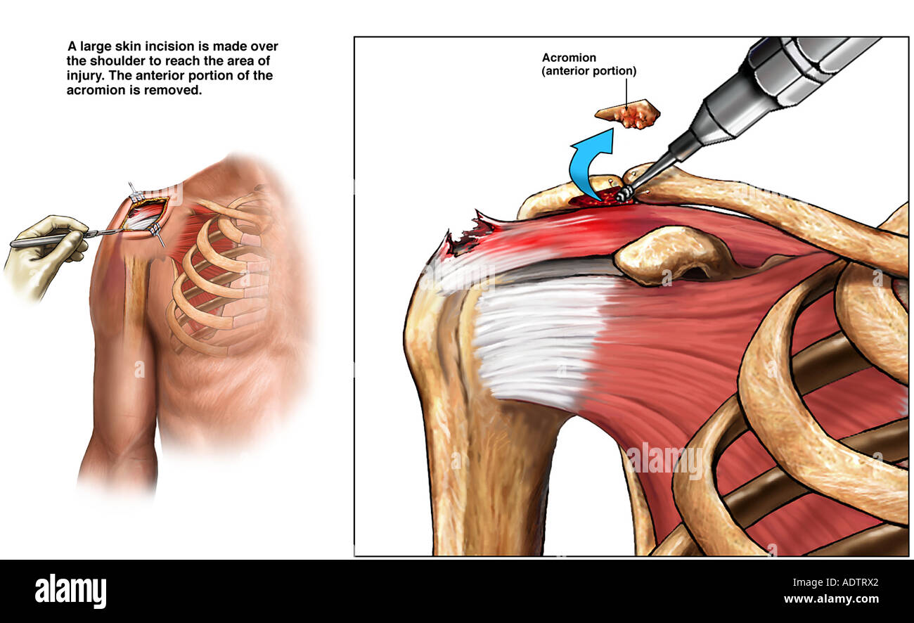 Op Bei Impingement Syndrom Schulter www.alamy.de