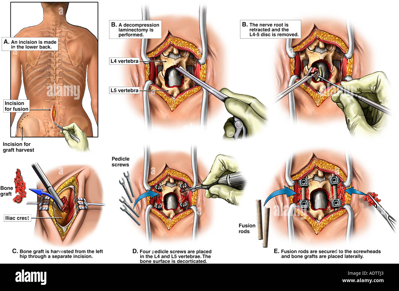 Rückenoperation - L4, L5 Laminektomie, L4-5 Diskektomie (Diskectomy) und  Spondylodese mit Pedikelschrauben und Stangen Stockfotografie - Alamy