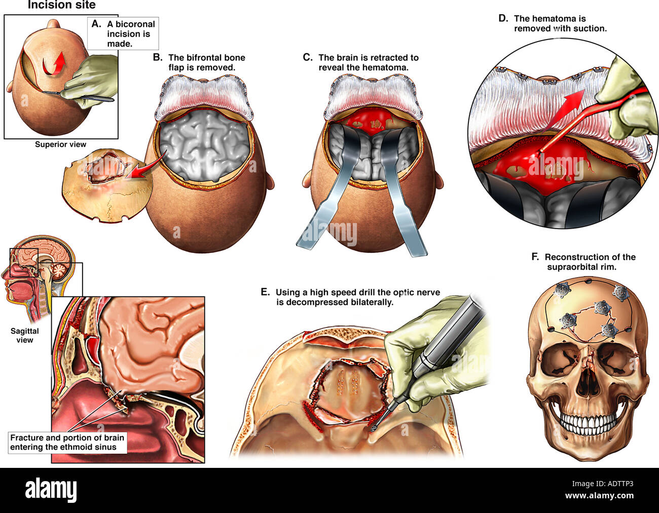 HirnOP Kraniotomie Verfahren zum Entfernen ein Hämatom Stockfoto, Bild 7710306 Alamy