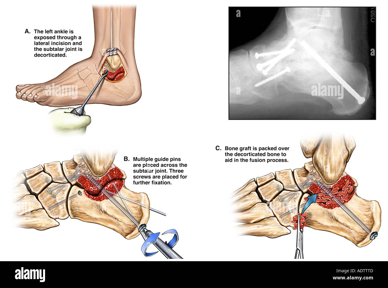 Foot bones x rays Fotos und Bildmaterial in hoher Auflösung Alamy