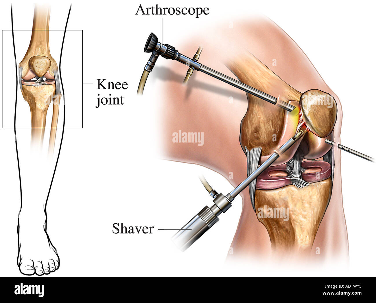 Arthroskopische Knie-Chirurgie-Orientierung Stockfoto