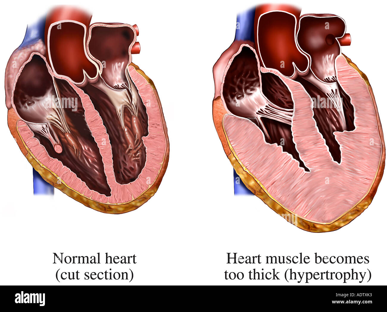 Желудочка сердца расширена. Гипертрофия кардиомиопатия. Кардиопатия гипертрофия. Дилатационная гипертрофия миокарда. Карнитиновая кардиомиопатия.