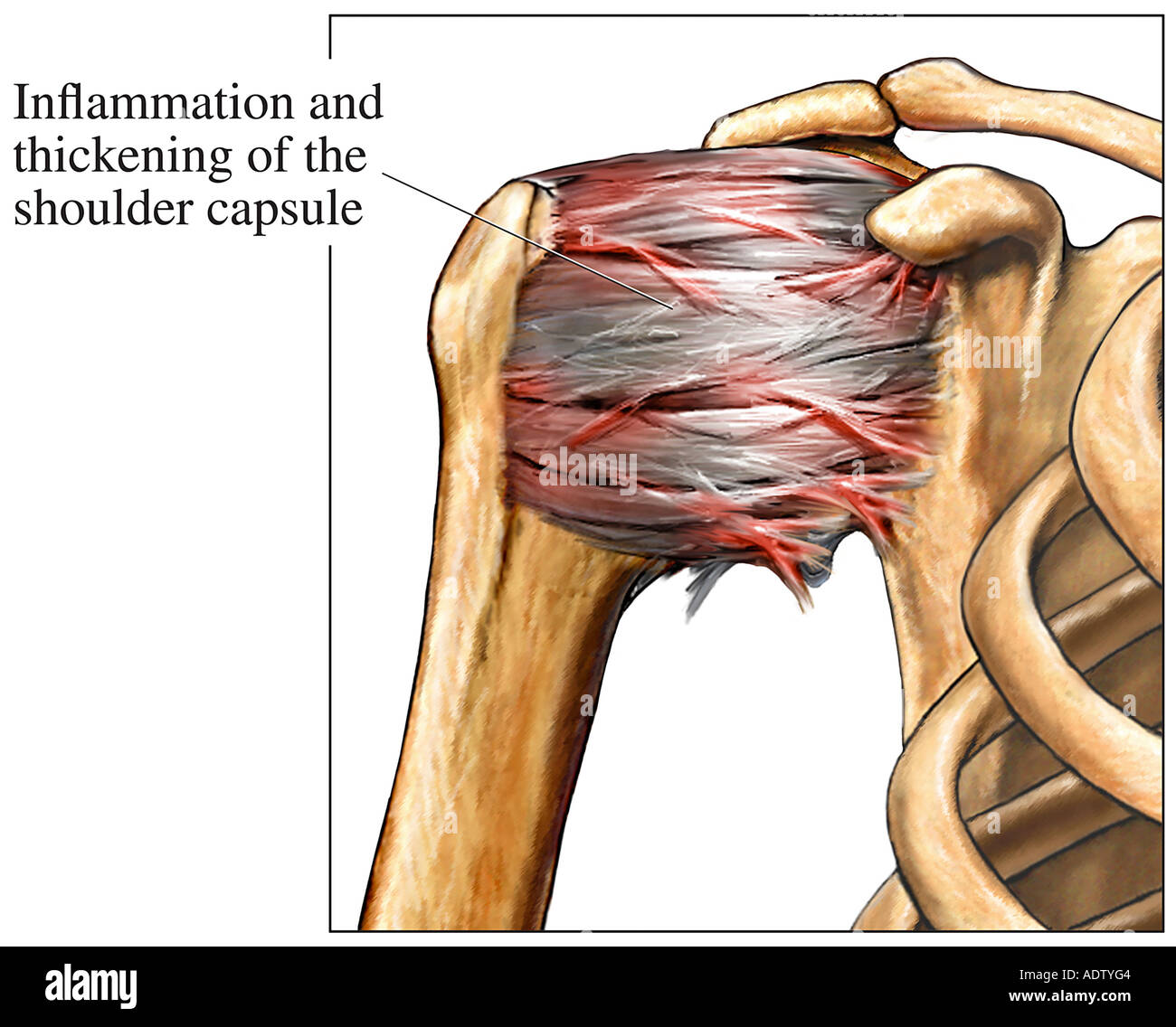 Anhaftenden Capsulitis der Schulter Stockfotografie Alamy