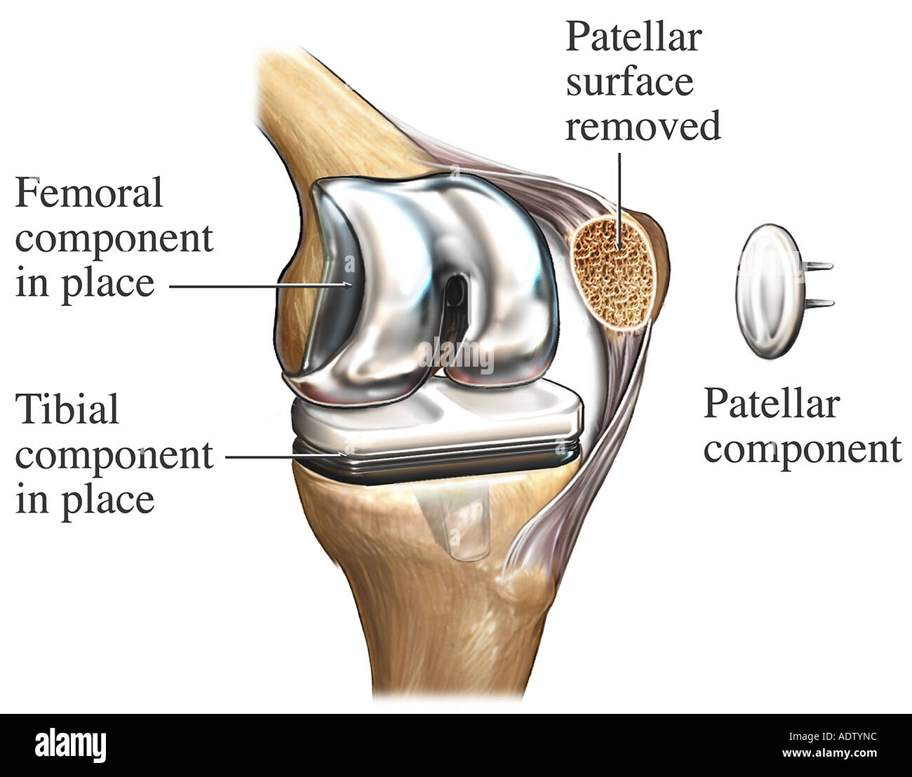 Total Prothesis Total knee replacement -Fotos und -Bildmaterial in hoher Auflösung – Alamy
