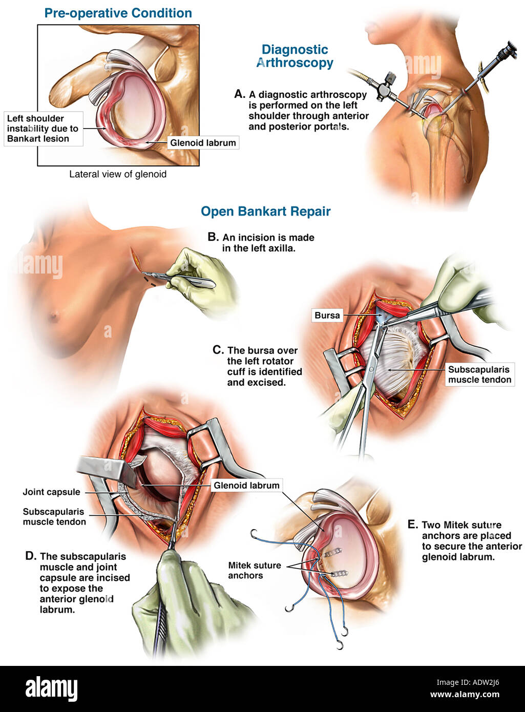 Linke Schulter Bankart Lasion Mit Arthroskopische Und Offene Reparatur Stockfotografie Alamy