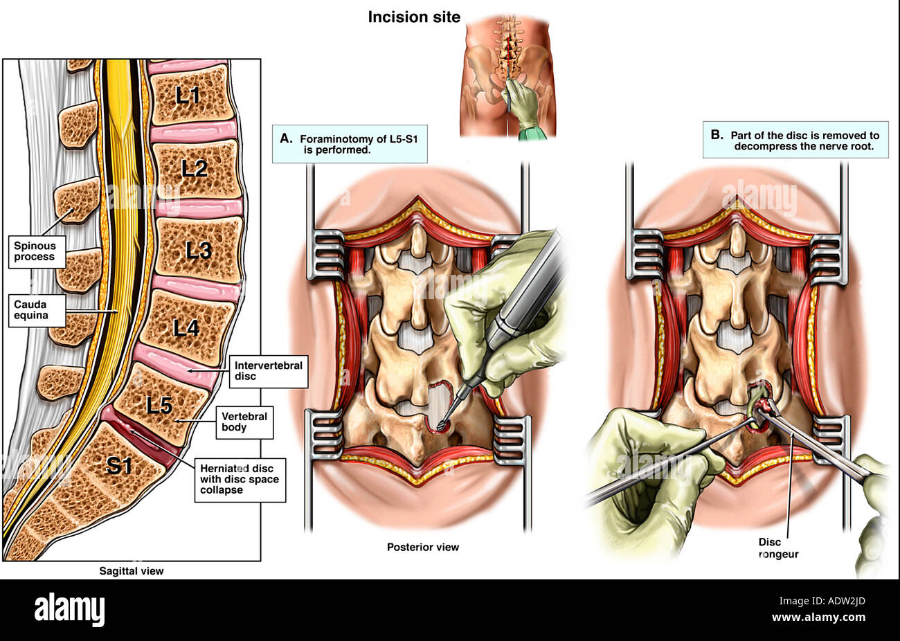 Дерматом l4-l5. Грыжа позвоночника поясничного отдела. Куда отдает грыжа. Куда отдает грыжа. Иннервация l4-l5.