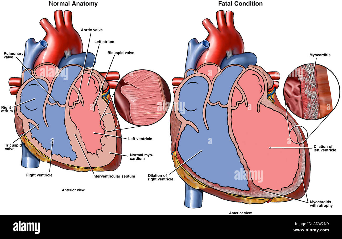 Tödliche Herzmuskelentzündung (Myokarditis Stockfotografie - Alamy