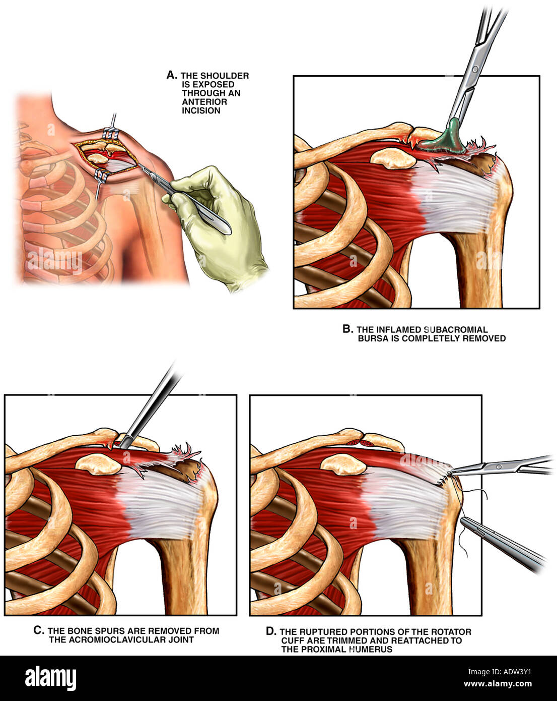 Schulter Op Acromioplastik Subakromialen Chirurgische Acromioplastik Subakromialen Bursectomy Und Rekonstruktion Der Rotatorenmanschette Stockfotografie Alamy