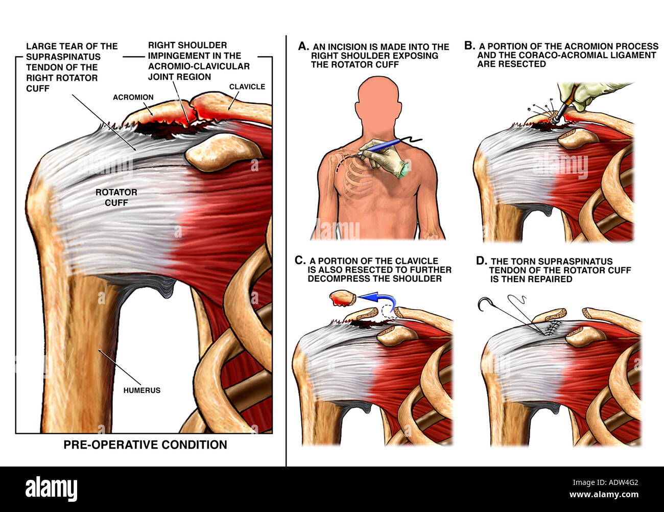 Rechte Schulter Impingement Und Der Rotatorenmanschette Mit Chirurgische Reparatur Stockfotografie Alamy